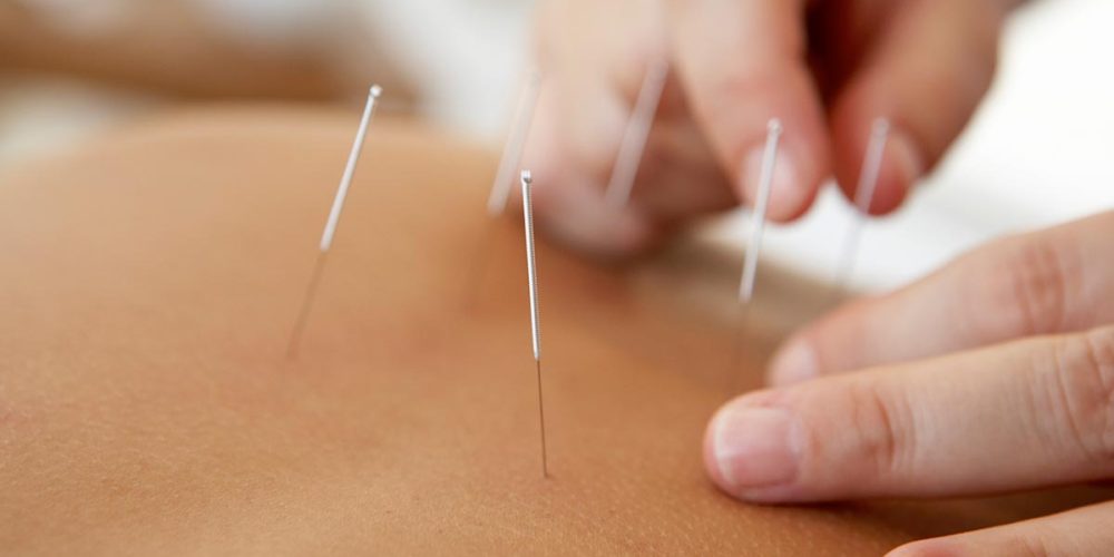 Acupuncture