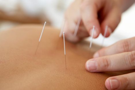 Acupuncture